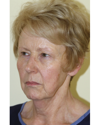 facelift patient before surgery with Rajiv Grover