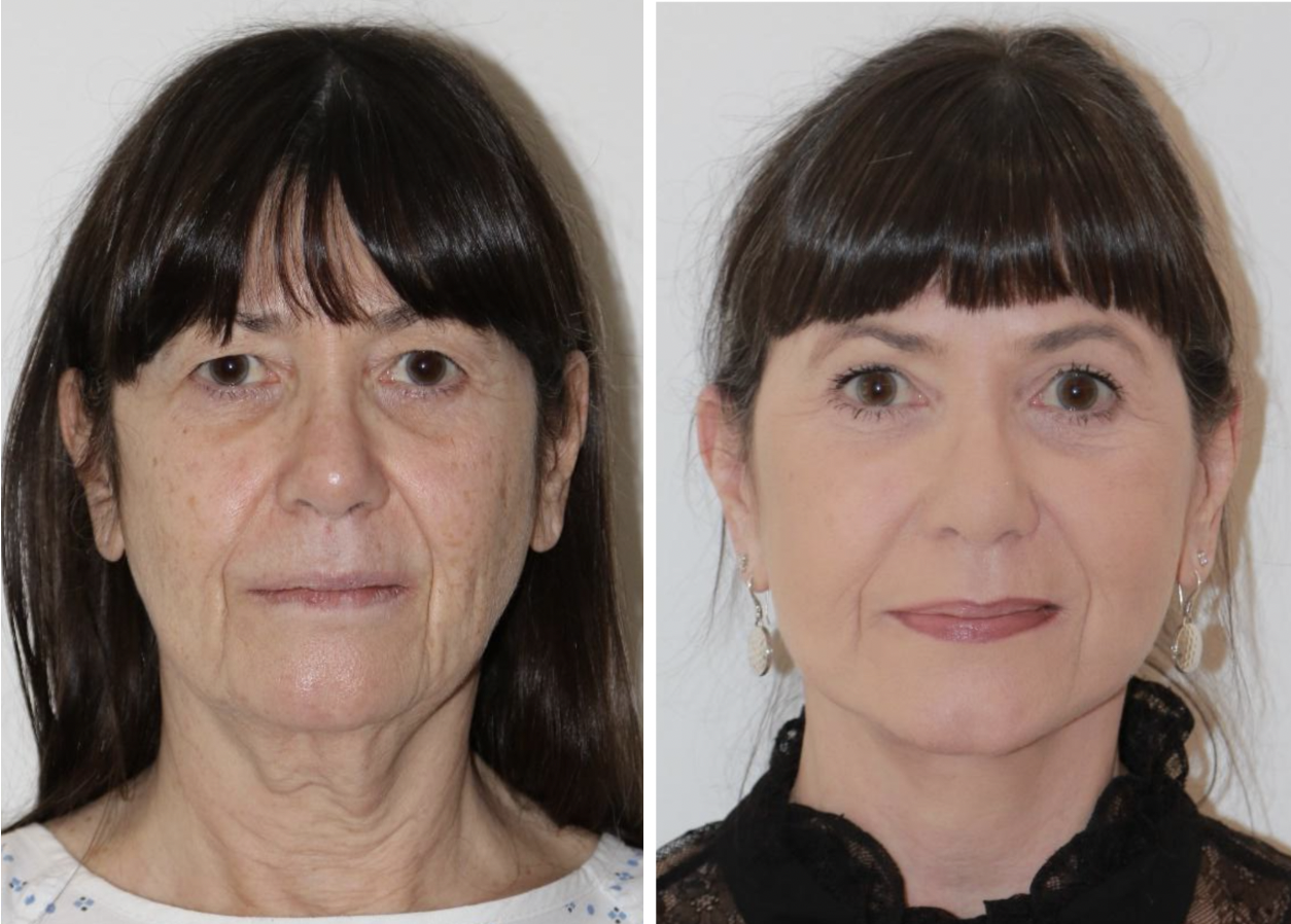 Facelift artistry before and after