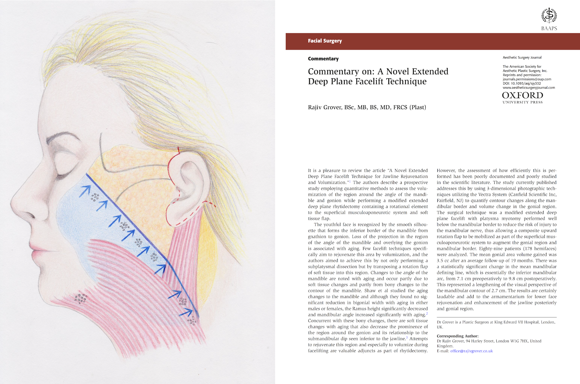 The Deep Plane Facelift Technique. Rajiv Grover was invited to publish a scientific commentary alongside Andrew Jacono’s Original work in the Aesthetic Surgery Journal (ASJ).