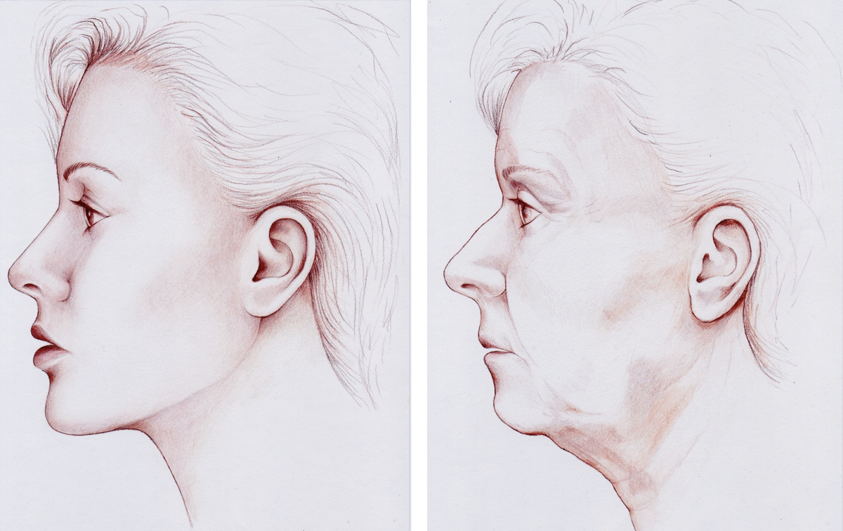 Facelift and Necklift Surgery Journey London UK Rajiv Grover